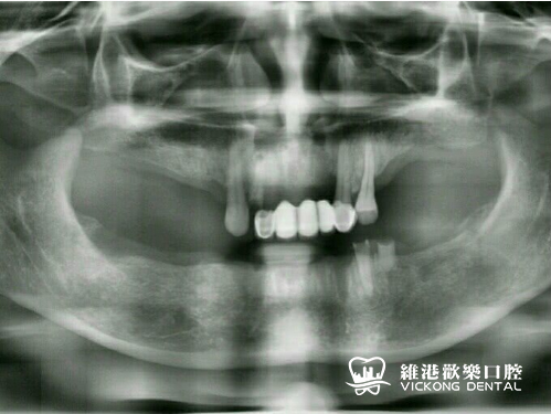 患者种牙前牙片