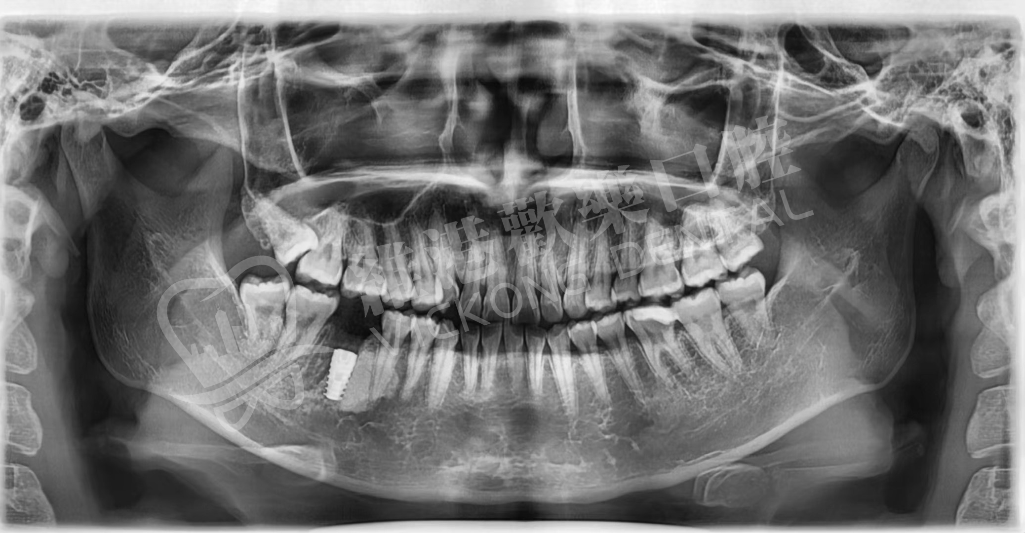 患者種植後牙片
