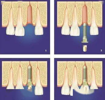 種植牙和傳統假牙有什麼區別？