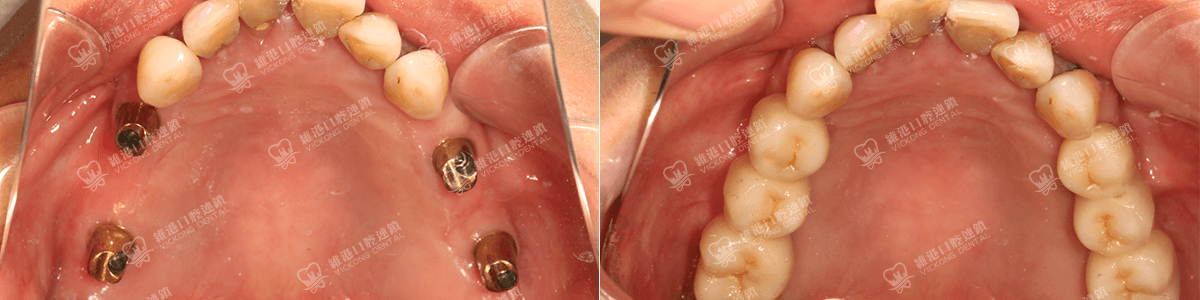 深圳種牙&深圳維港口腔