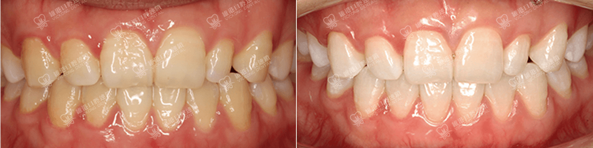 深圳種牙&深圳維港口腔