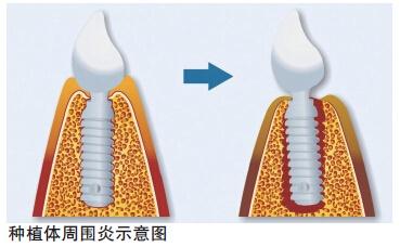 美发现种植体周围炎相关异物成分 