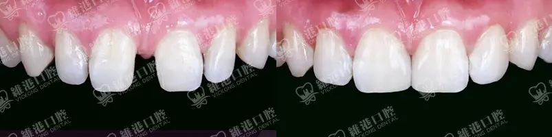 深圳種牙&深圳維港口腔