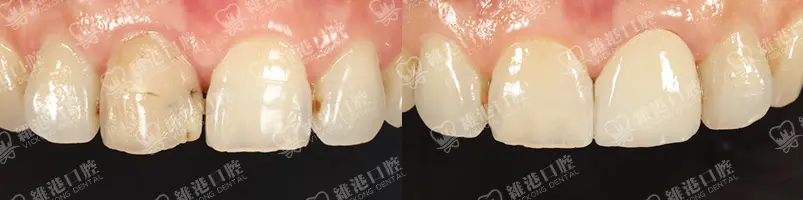 深圳種牙&深圳維港口腔