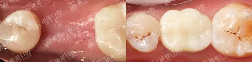 深圳種牙&深圳維港口腔