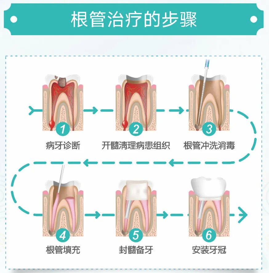 根管治療