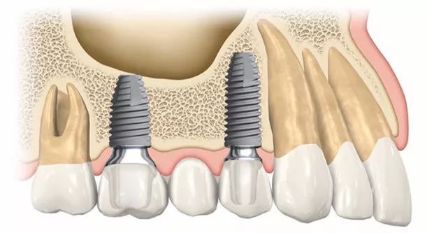 种植牙2