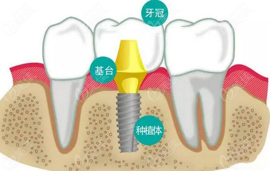 种植牙