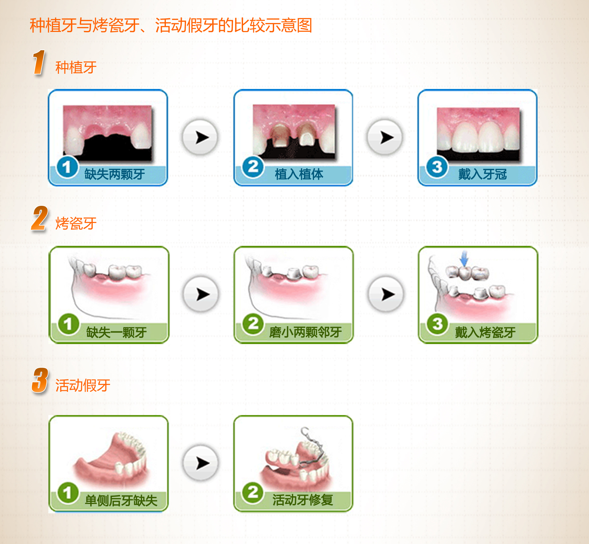 牙齒缺失修復方式