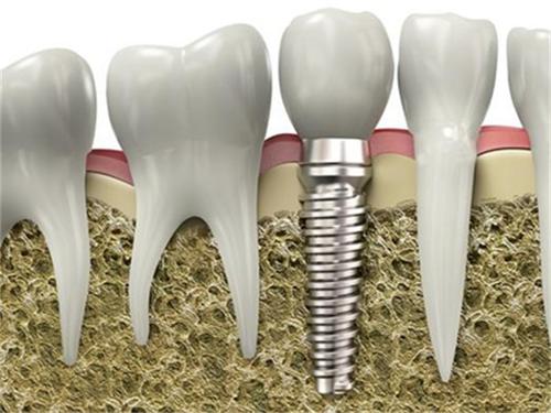 深圳種植牙