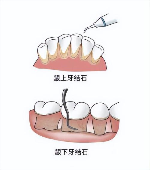 牙周治療圖