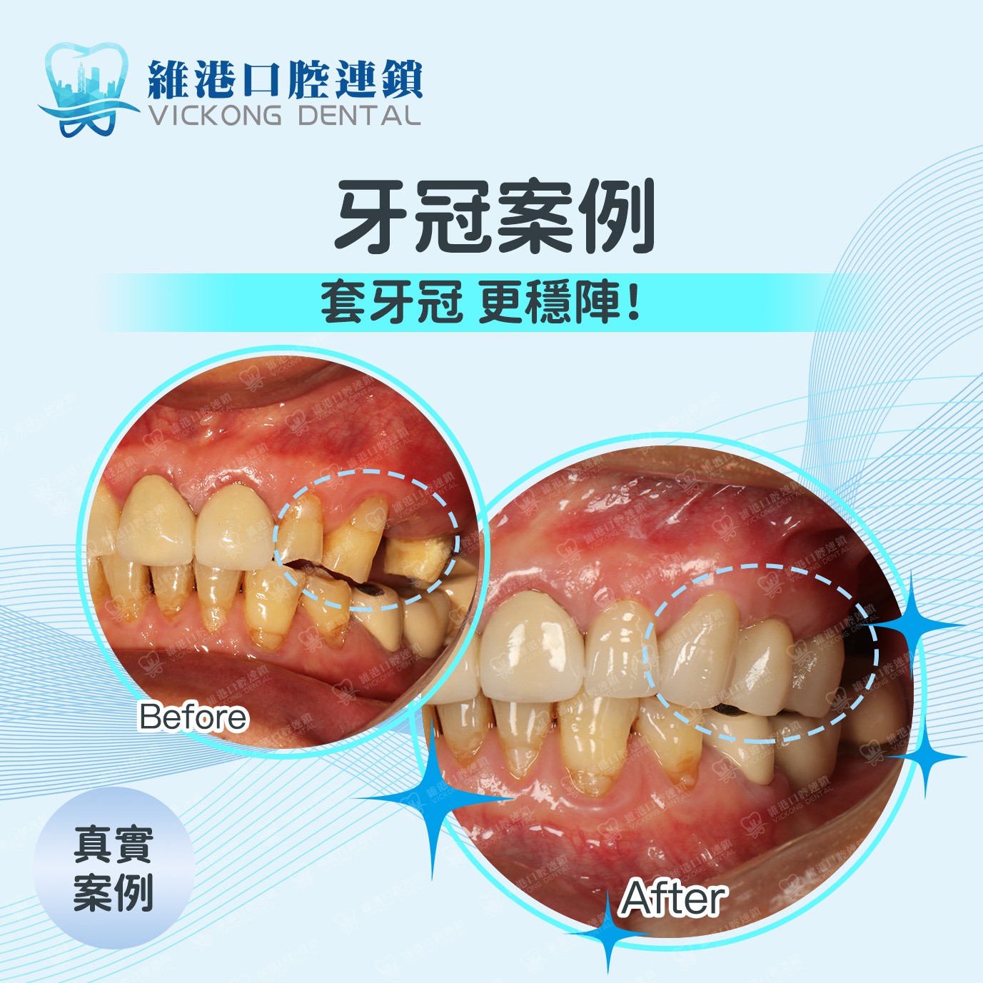牙冠案例