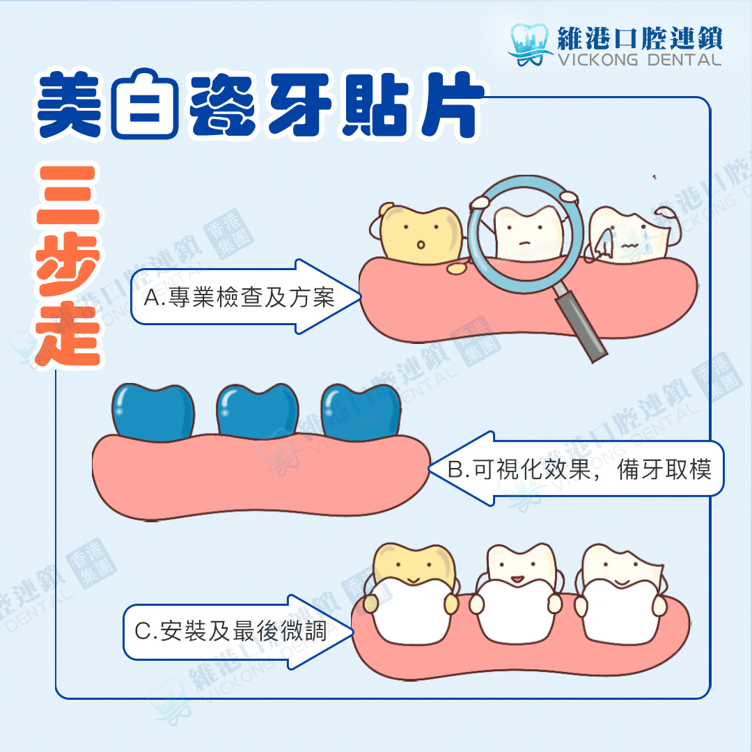 深圳美白全瓷牙贴片步骤