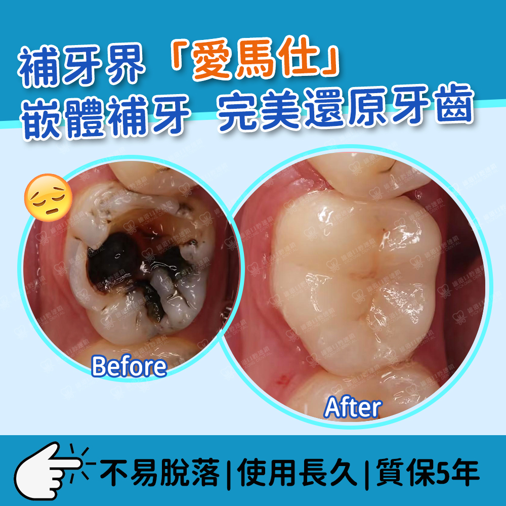 維港口腔補牙前後對比圖，補牙效果圖