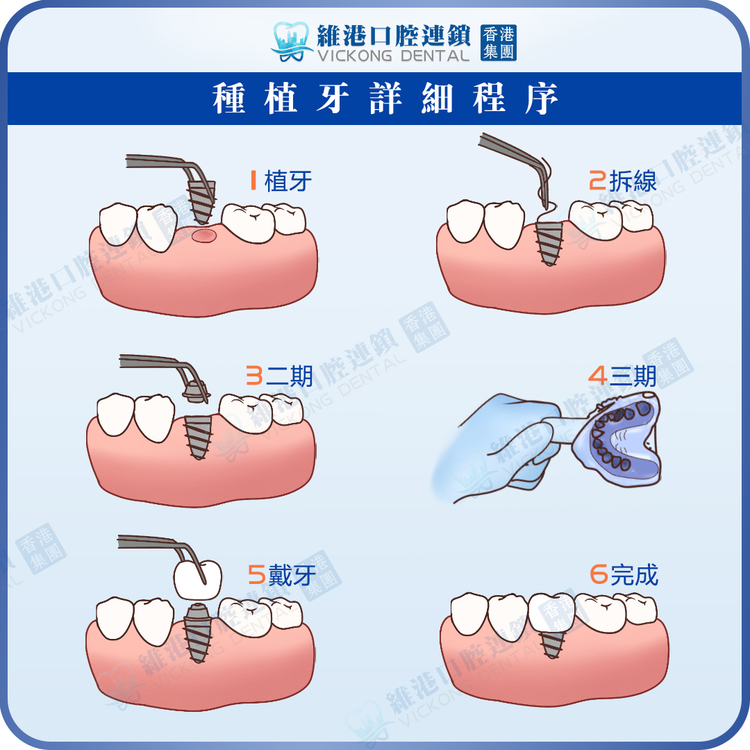 种牙详细流程