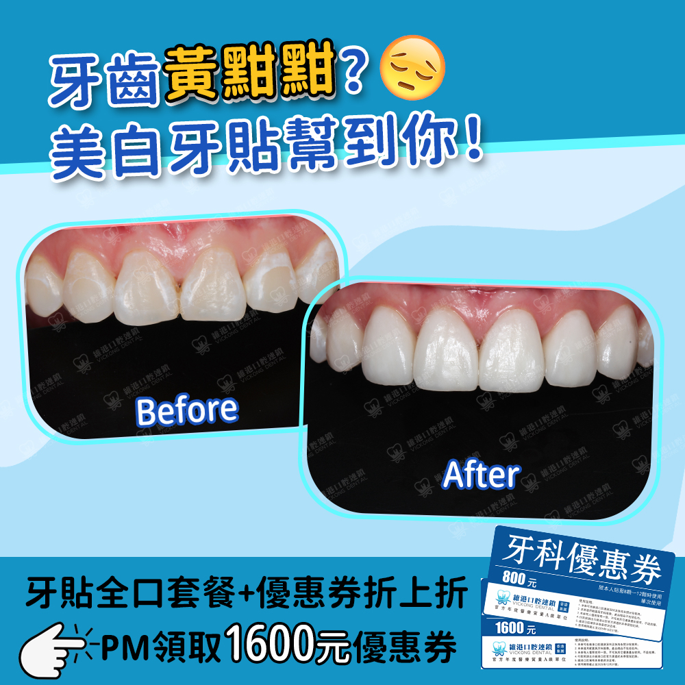 美白牙贴面 美白牙贴面