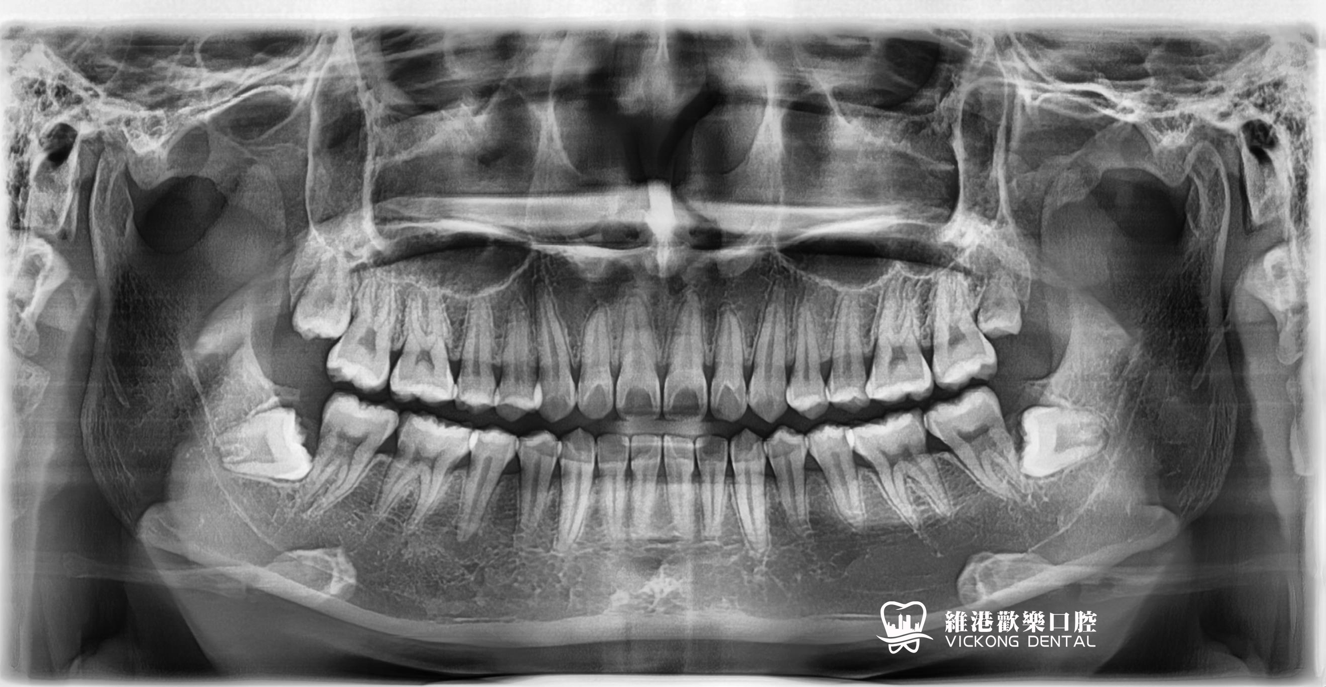 患者牙片檢查