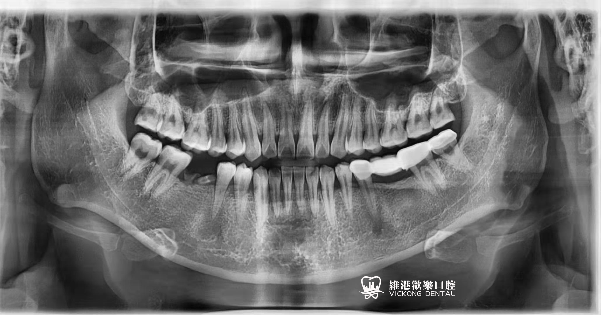 患者種牙前牙片