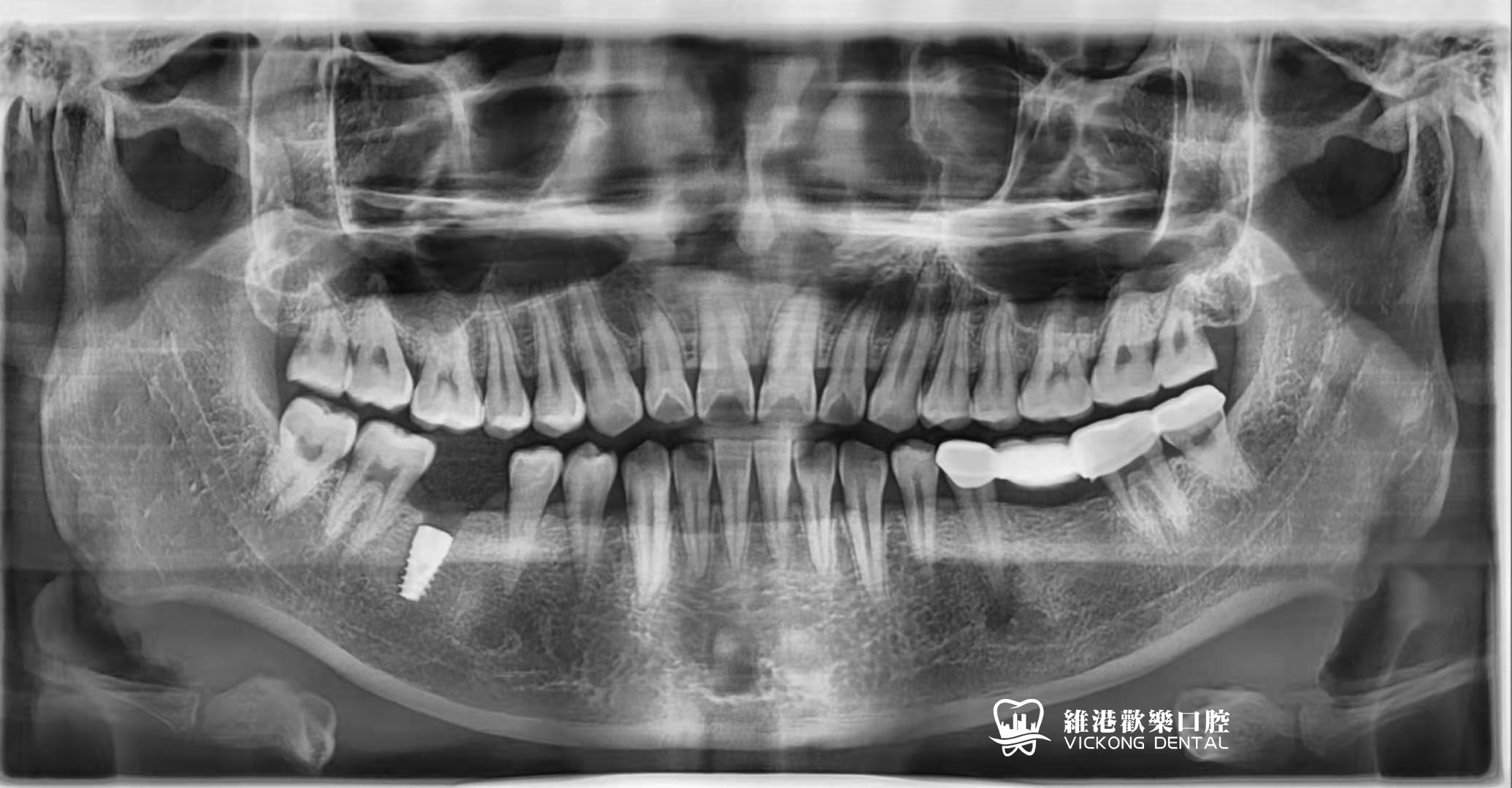患者種牙後牙片