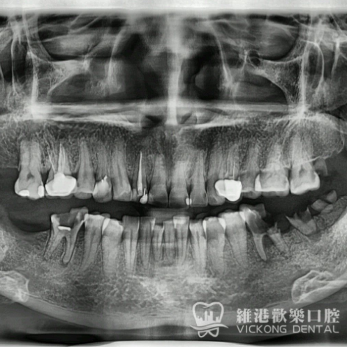 患者牙片檢查