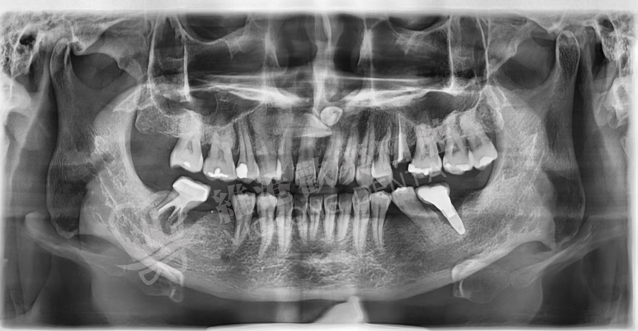 患者種植前牙片