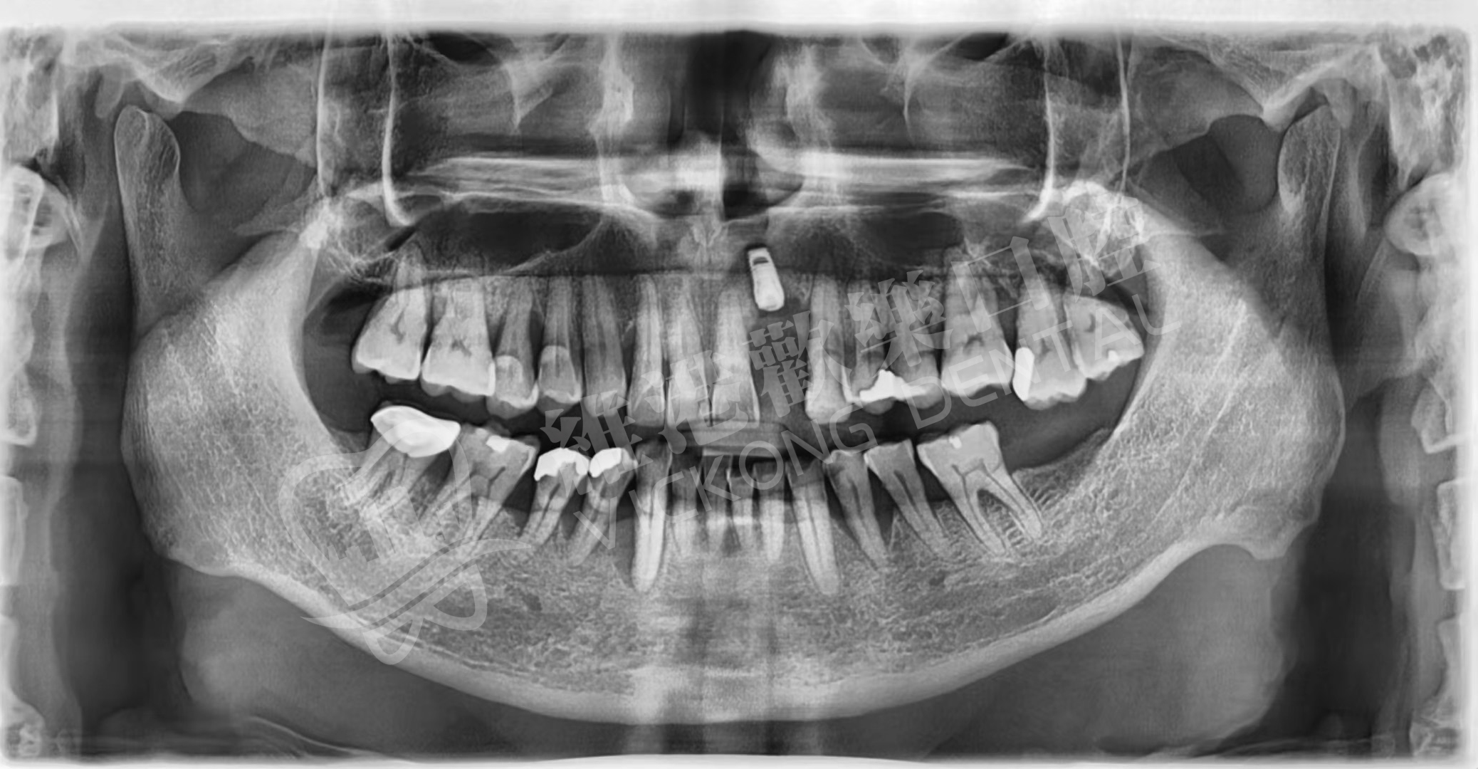 患者種植後牙片