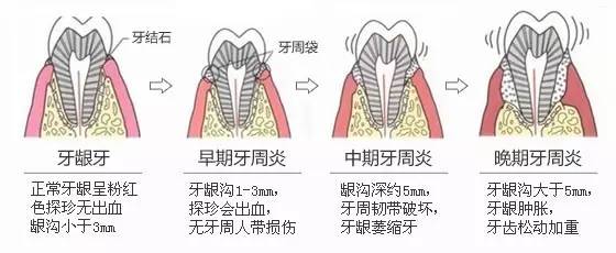 牙周炎