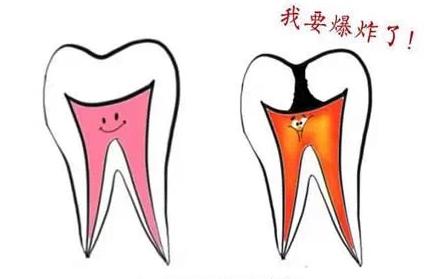 急性牙髓炎-牙痛-维港口腔连锁-维港欢笑口腔-维港欢乐口腔