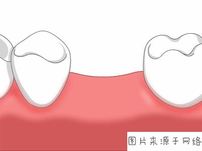 深圳活動假牙價錢