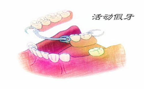 深圳全口假牙