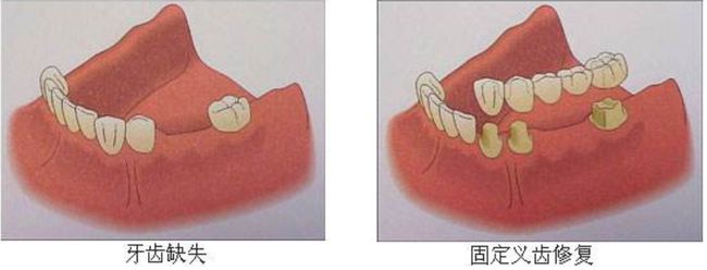 固定假牙價格