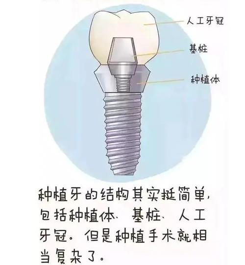 深圳種植牙