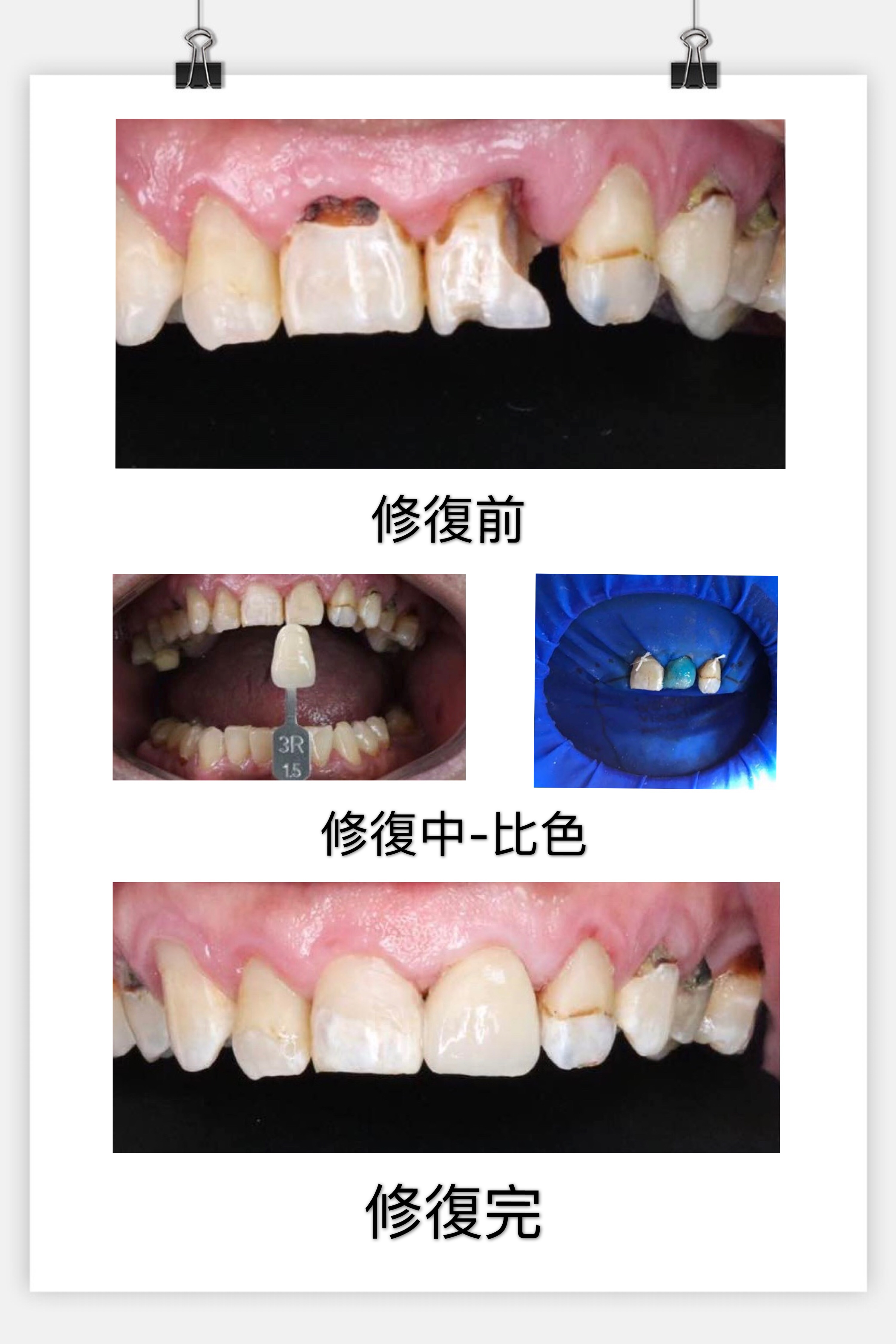 門牙牙貼面修復