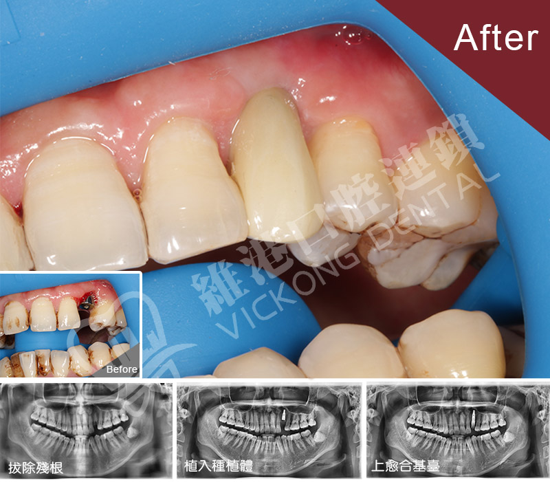 深圳劉生前牙種植牙案例