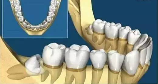 你瞭解智齒嗎？