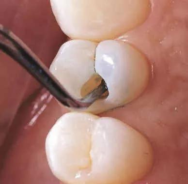 什麼是根管治療？根管治疔完成後還要做牙套嗎？