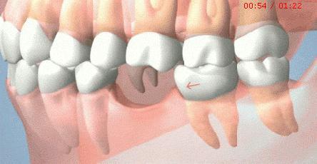 重做假牙前為什麼要停戴舊假牙呢？假牙應該怎麼清洗乾淨？