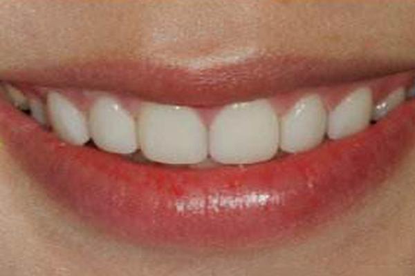 活動假牙會變色嗎？為什麼有時活動假牙越戴越松？