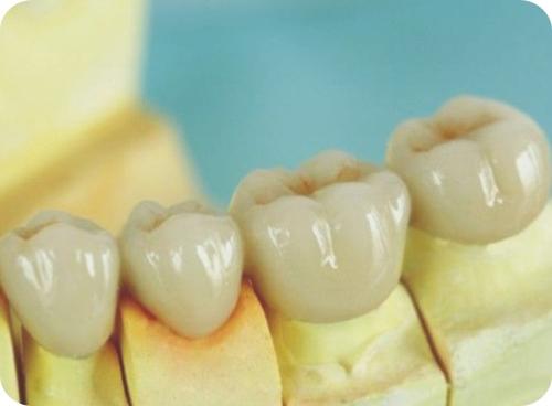 為什麼做牙冠修復，有時要先做極管治疔？做烤瓷牙時需要磨真牙？
