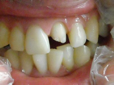 做烤瓷牙有年稔限制嗎？烤瓷牙的牙齒發炎疼痛是否需要拆除？