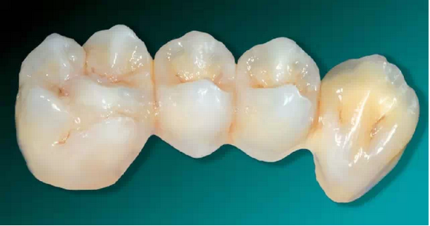 在什麼情況下需要拆除固定牙套、修復體？烤瓷牙出現崩瓷現象該怎麼辦？