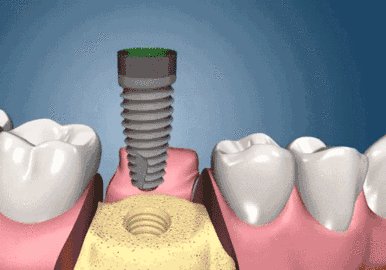 種植牙可以作為固定牙橋的的基牙嗎？