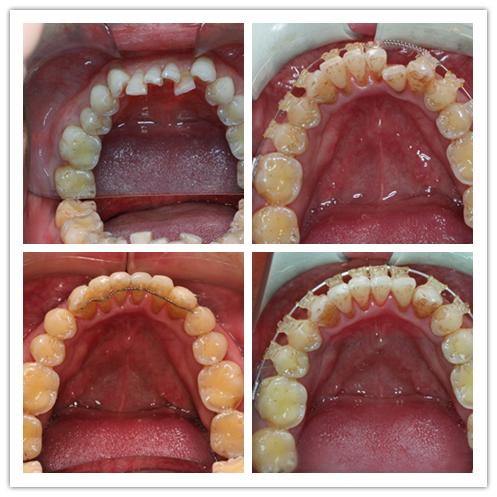牙齒矯正都要經歷怎樣的過程？