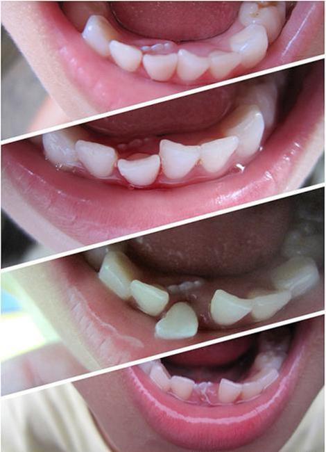 兒童的齲病有什麼特點？兒童牙髓病的症狀有什麼特點？